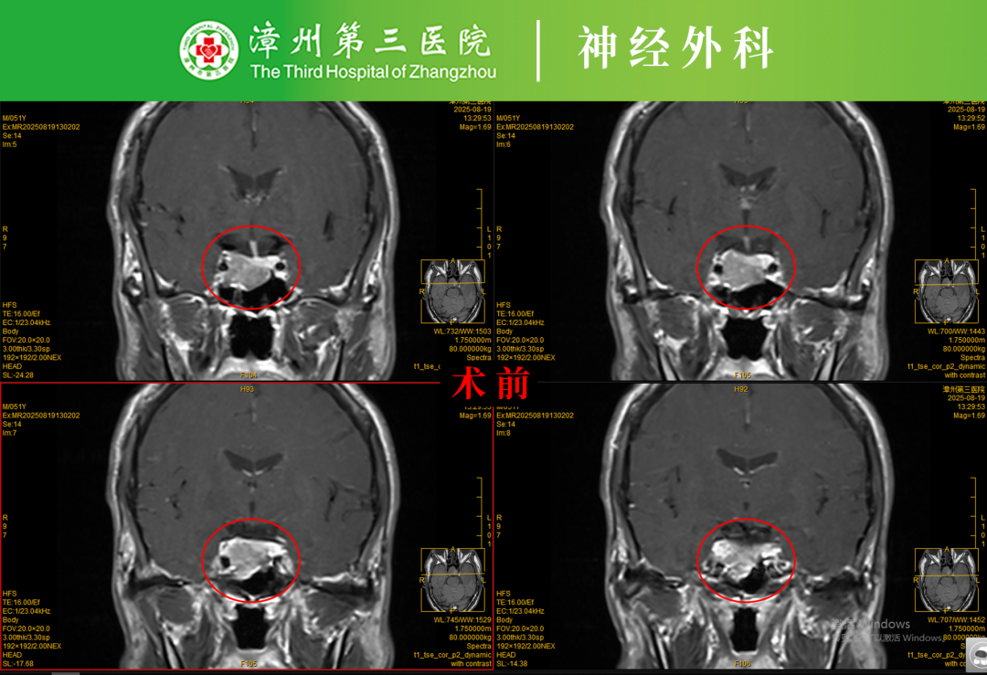 不用开颅，微创切除脑肿瘤
