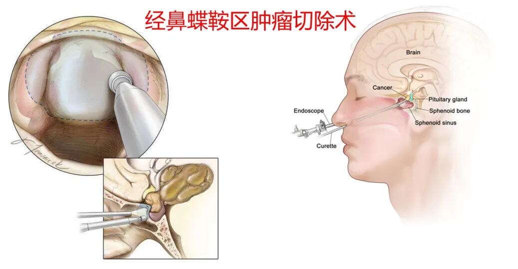 不用开颅，微创切除脑肿瘤