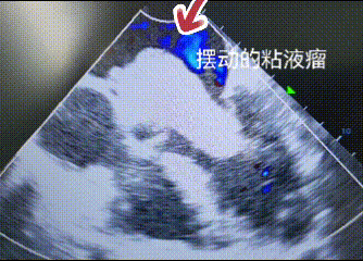 52 岁的她急性脑梗，竟查出心脏肿瘤！医生提醒：脑梗背后可能藏着 「心隐患」