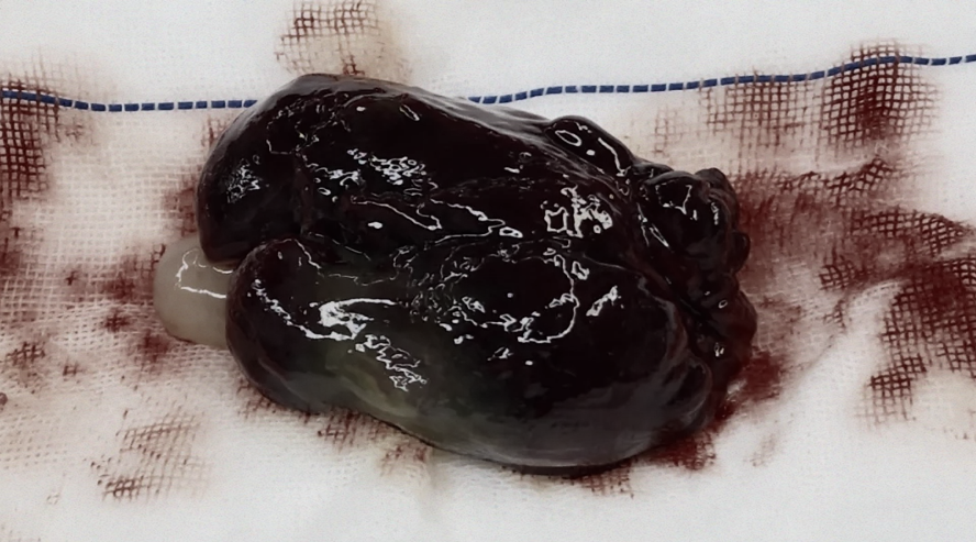 52 岁的她急性脑梗，竟查出心脏肿瘤！医生提醒：脑梗背后可能藏着 「心隐患」