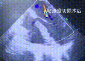 52 岁的她急性脑梗，竟查出心脏肿瘤！医生提醒：脑梗背后可能藏着 「心隐患」