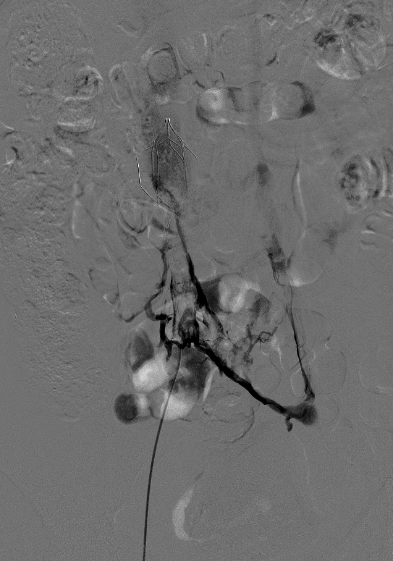 区域急救联动，3 小时解除下肢深静脉高负荷血栓危机