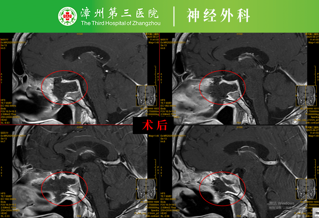 不用开颅，微创切除脑肿瘤