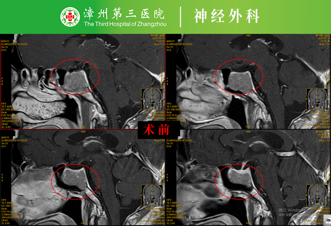 不用开颅，微创切除脑肿瘤