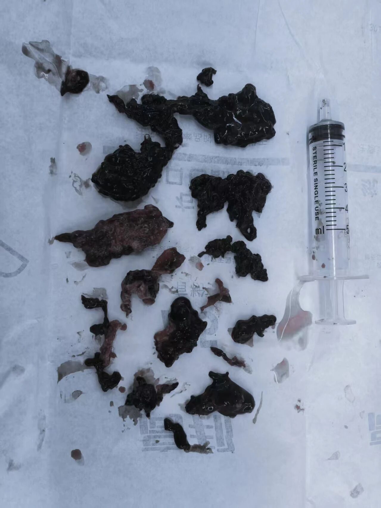 区域急救联动，3 小时解除下肢深静脉高负荷血栓危机