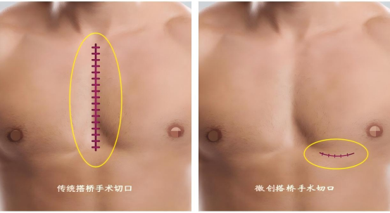 心脏「修路」不用「拆墙」？大爷听后乐开了花！