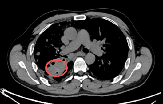 肺结核后暗藏的致命动脉瘤，如何精准拆弹？
