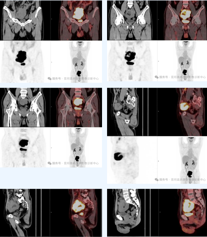 【高尚病例】两月前便血，PET/CT 发现淋巴瘤