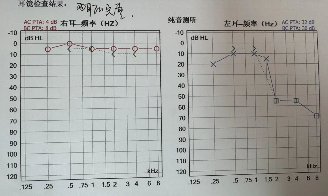 发病率上涨 3 倍多,别让突发性耳聋「偷走」你的听力!