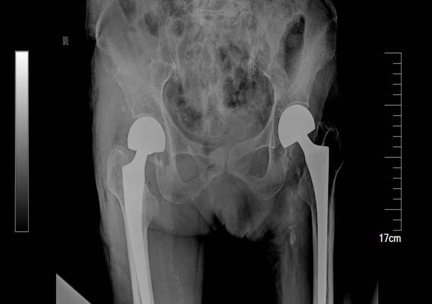 98 岁髋部骨折老人重新站立,多学科协作跨越手术「年龄禁区」