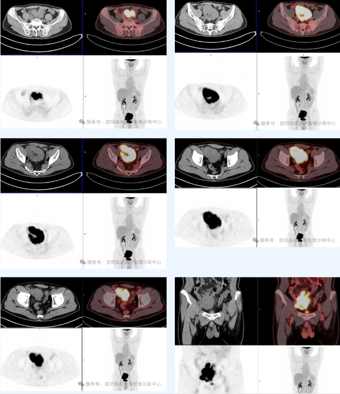 【高尚病例】两月前便血，PET/CT 发现淋巴瘤