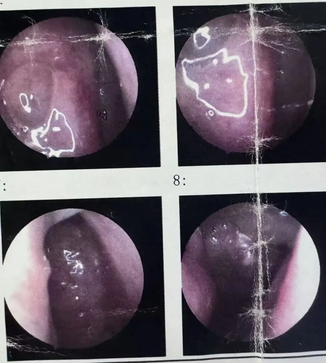 健康指导: 鼻息肉术前不用慌,这些注意事项要记牢