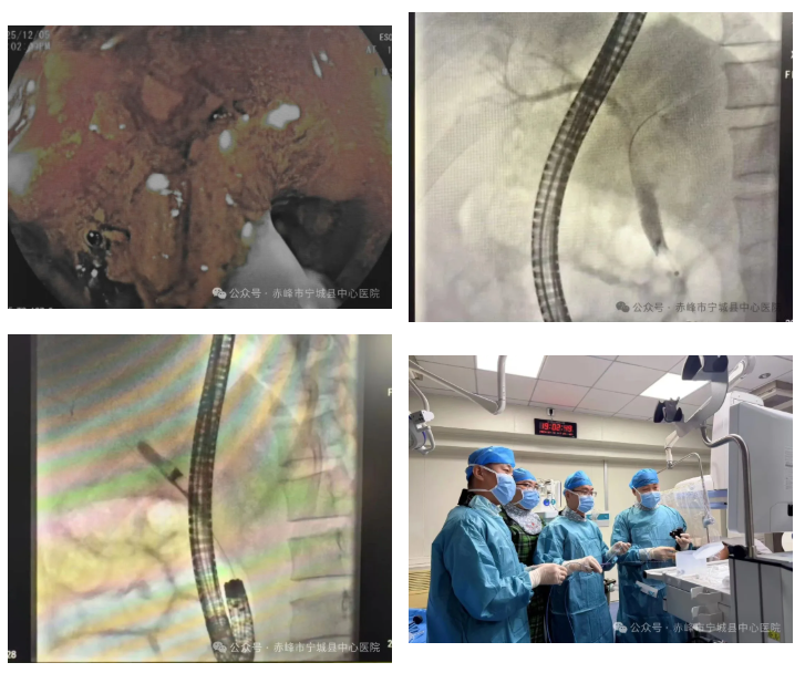 宁城县中心医院完成胃大部切除术后 ERCP 手术,为患者提供新治疗路径