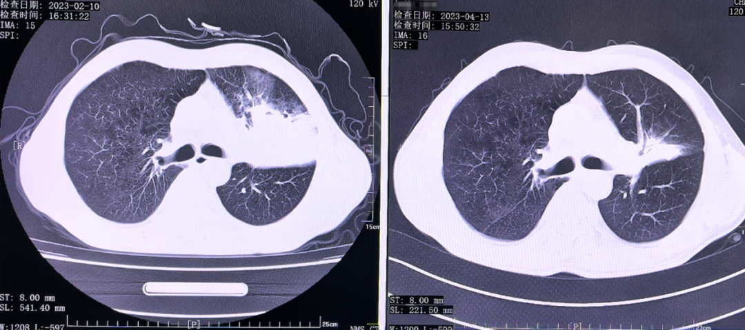 被判「无法手术」的肺癌，如何绝处逢生？