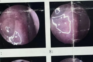 健康指导： 鼻息肉术前不用慌，这些注意事项要记牢