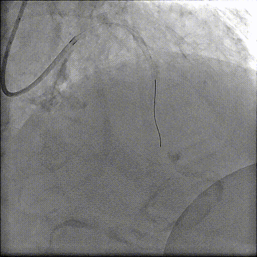 八旬老人重获「心」生：PCI+TAVR 一站式手术破解心脏难题