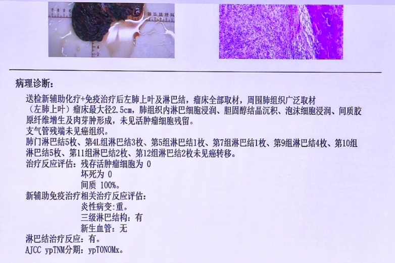 被判「无法手术」的肺癌，如何绝处逢生？