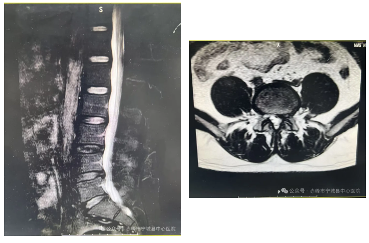 宁城县中心医院骨科四病区开展脊椎单侧双通道内镜技术，助力脊椎疾病治疗