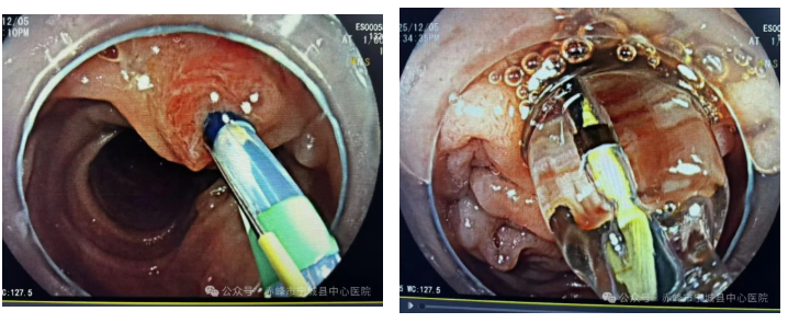 宁城县中心医院完成胃大部切除术后 ERCP 手术,为患者提供新治疗路径