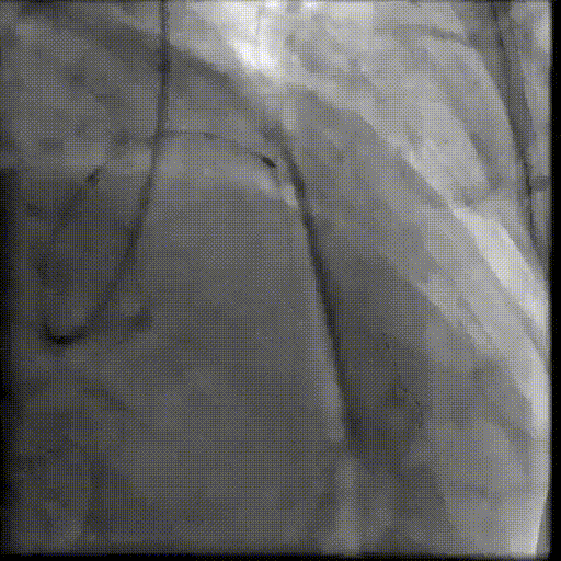 八旬老人重获「心」生：PCI+TAVR 一站式手术破解心脏难题