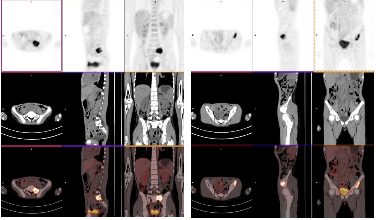 颈部包块不消退？尤其是儿童，要警惕淋巴瘤