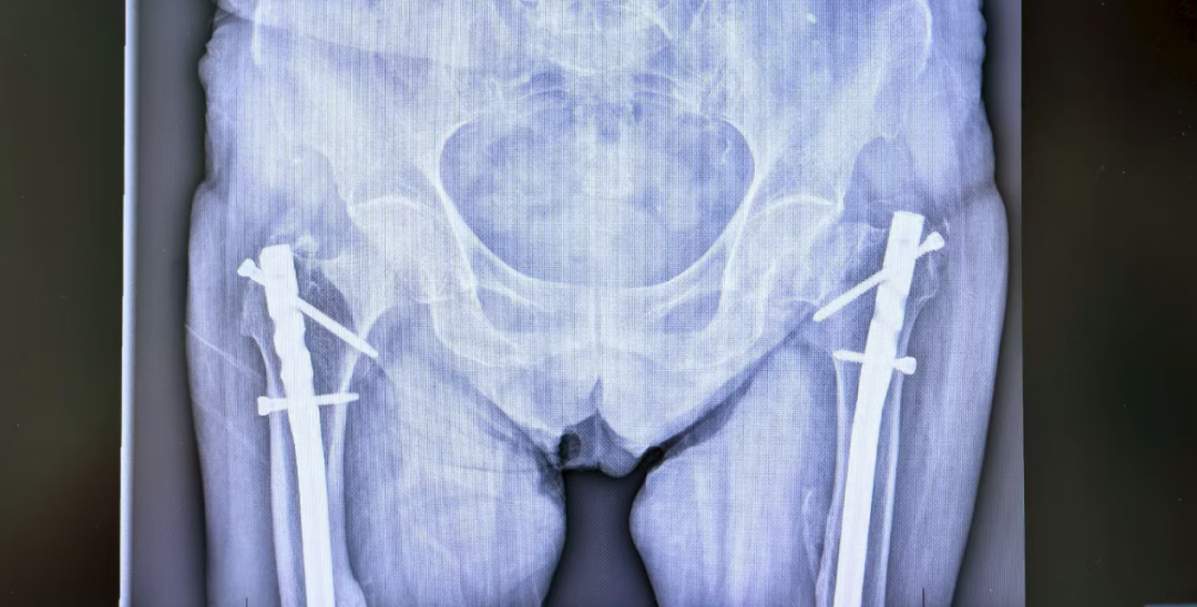 全身骨头「漏钙」，竟是胸腔里多了个「器官」？