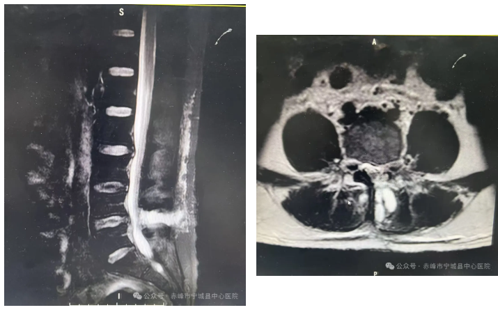 宁城县中心医院骨科四病区开展脊椎单侧双通道内镜技术，助力脊椎疾病治疗