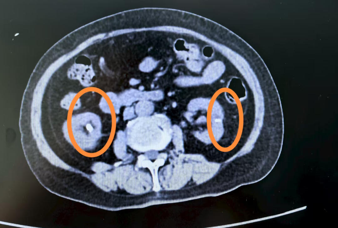 全身骨头「漏钙」，竟是胸腔里多了个「器官」？