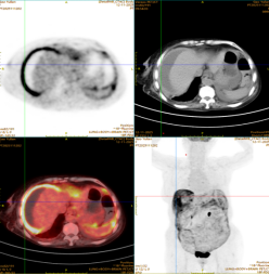 隐秘的健康警报，两例特殊病例揭示诊治关键