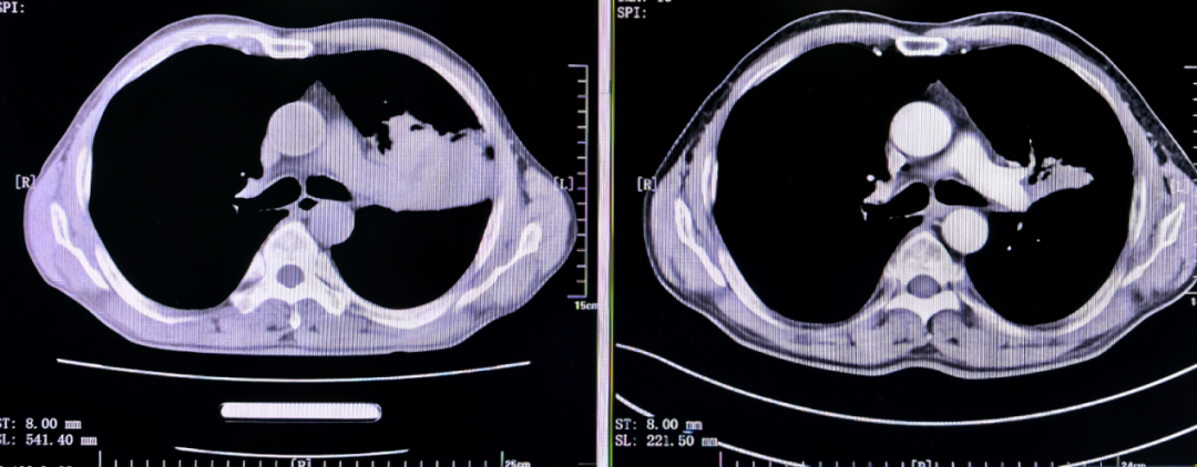 被判「无法手术」的肺癌，如何绝处逢生？