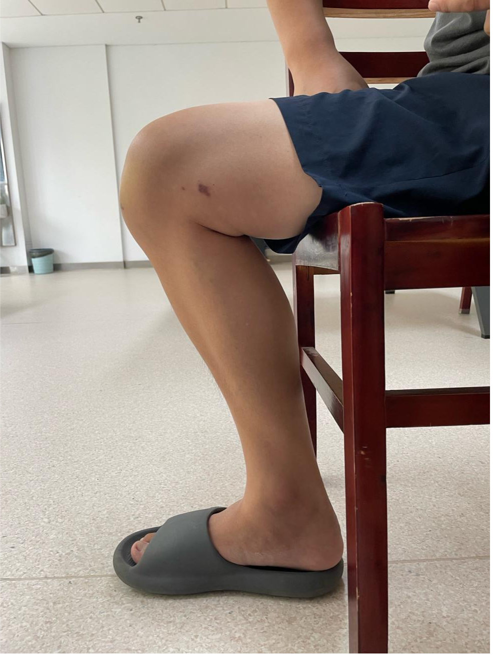 多学科协作精准破局!膝关节术后僵硬患者重获关节自由