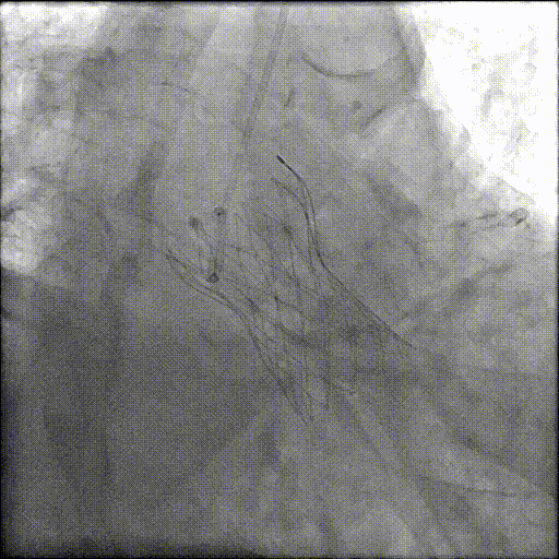 八旬老人重获「心」生：PCI+TAVR 一站式手术破解心脏难题