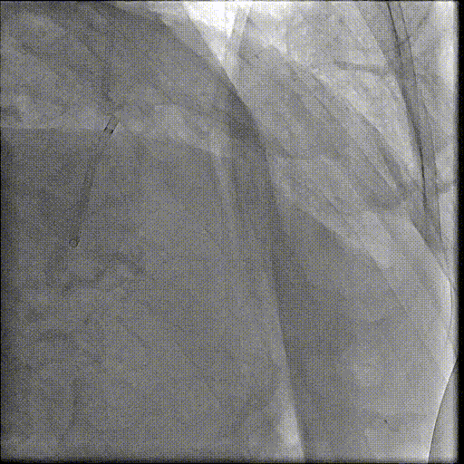 八旬老人重获「心」生：PCI+TAVR 一站式手术破解心脏难题