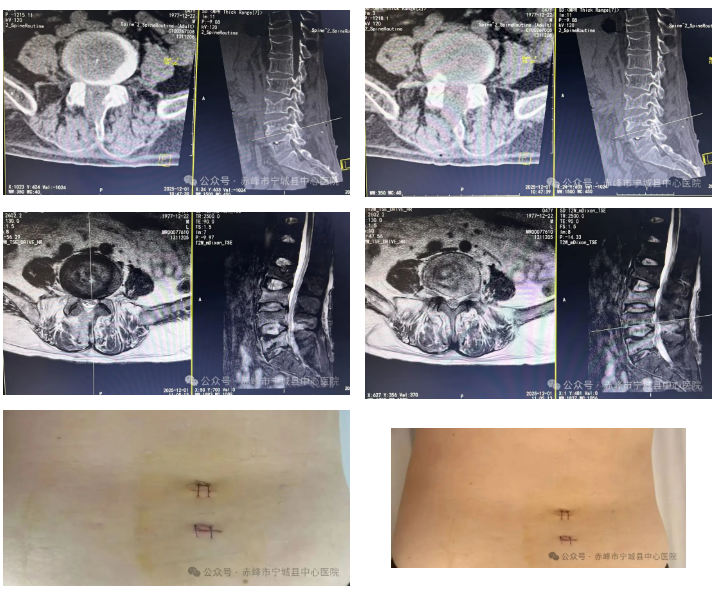 宁城县中心医院骨科四病区开展脊椎单侧双通道内镜技术，助力脊椎疾病治疗