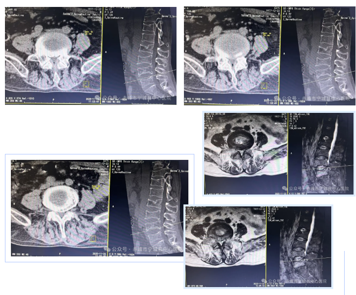 宁城县中心医院骨科四病区开展脊椎单侧双通道内镜技术，助力脊椎疾病治疗