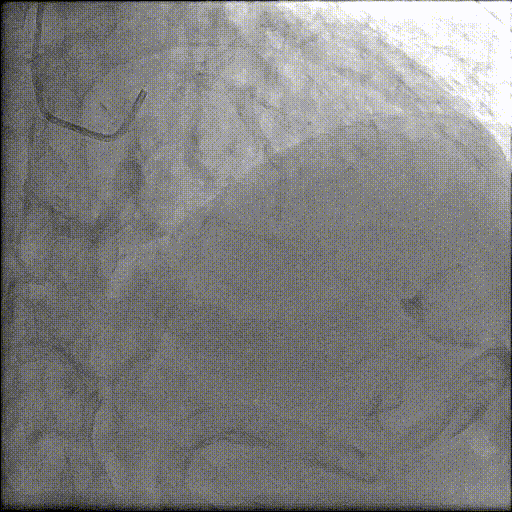 八旬老人重获「心」生：PCI+TAVR 一站式手术破解心脏难题