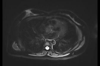 如何克服做磁共振检查的恐惧？