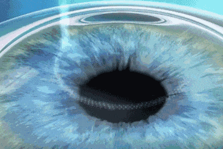 2026 征兵摘镜必看：近视手术须提前半年