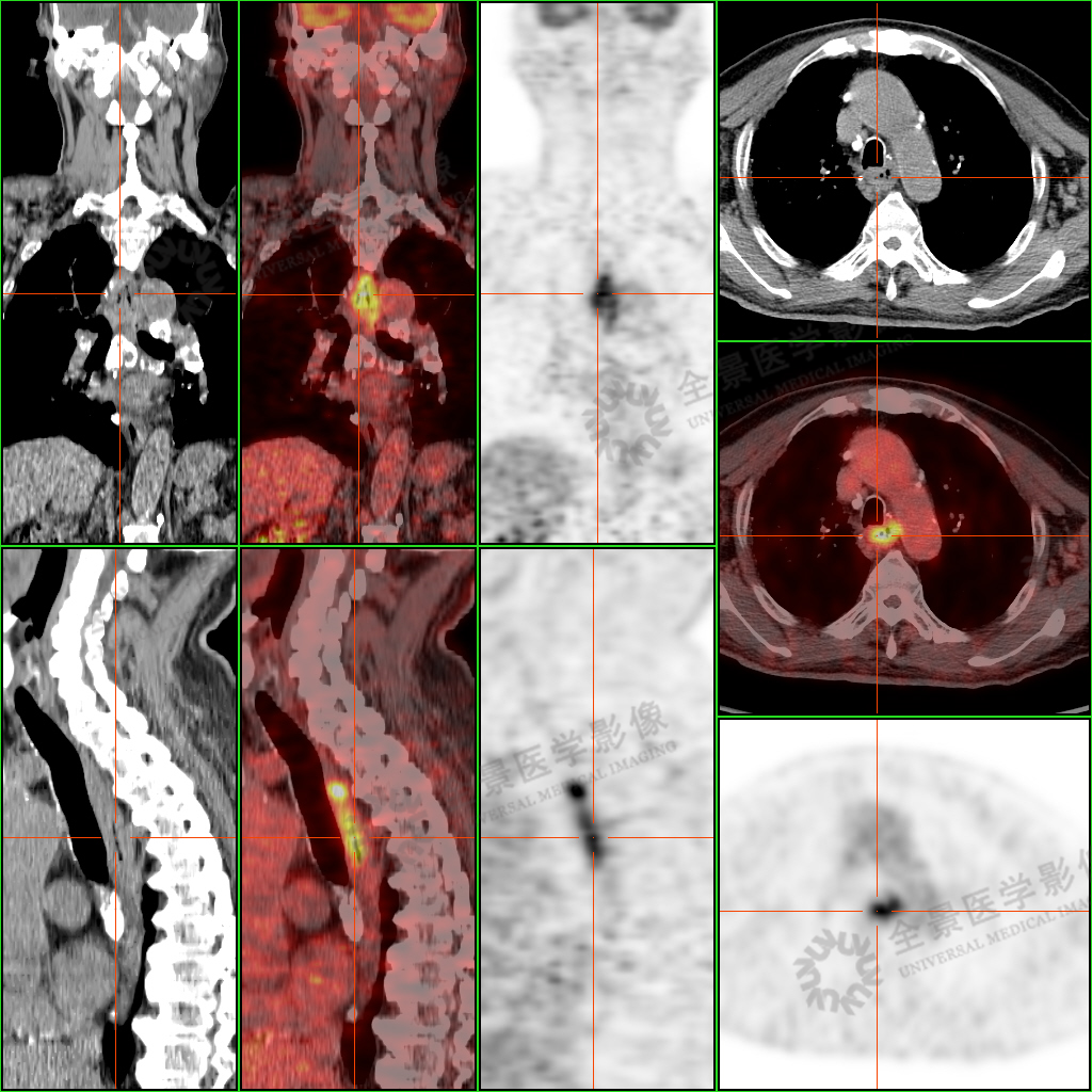 双腿乏力 1 年未愈,PET/CT 揪出隐匿健康隐患