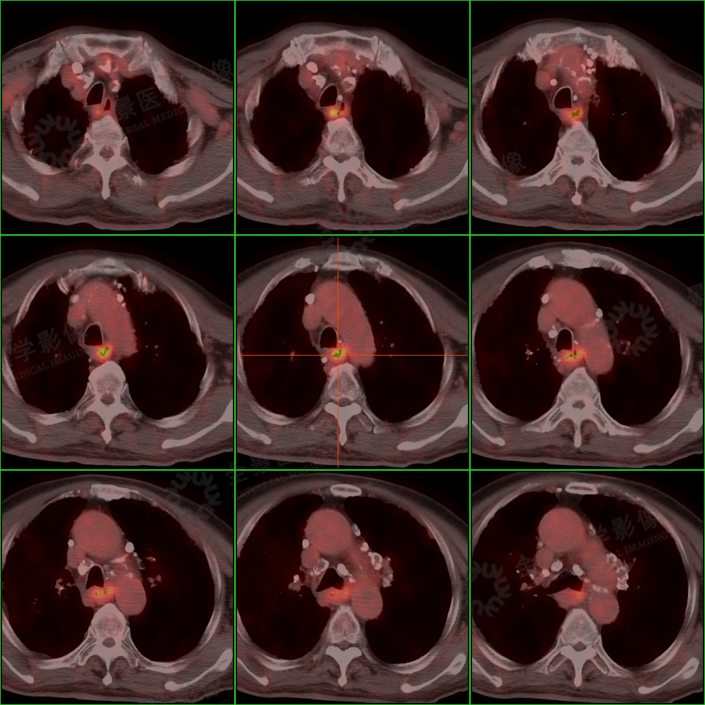 双腿乏力 1 年未愈,PET/CT 揪出隐匿健康隐患