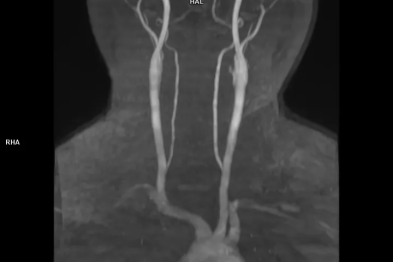 血压居高不下，当心心脏被「撑大」