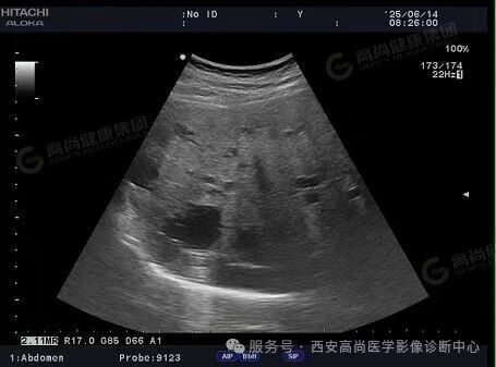 【高尚病例】多囊肝多囊肾
