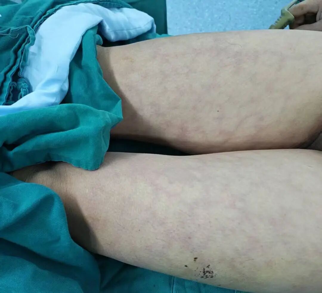 多学科无缝联动！南京江北医院心脏中心成功救治破裂休克 A 型主动脉夹层，破解「致命夹层」危机