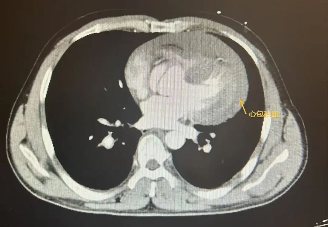 多学科无缝联动！南京江北医院心脏中心成功救治破裂休克 A 型主动脉夹层，破解「致命夹层」危机