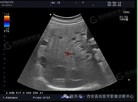 【高尚病例】多囊肝多囊肾