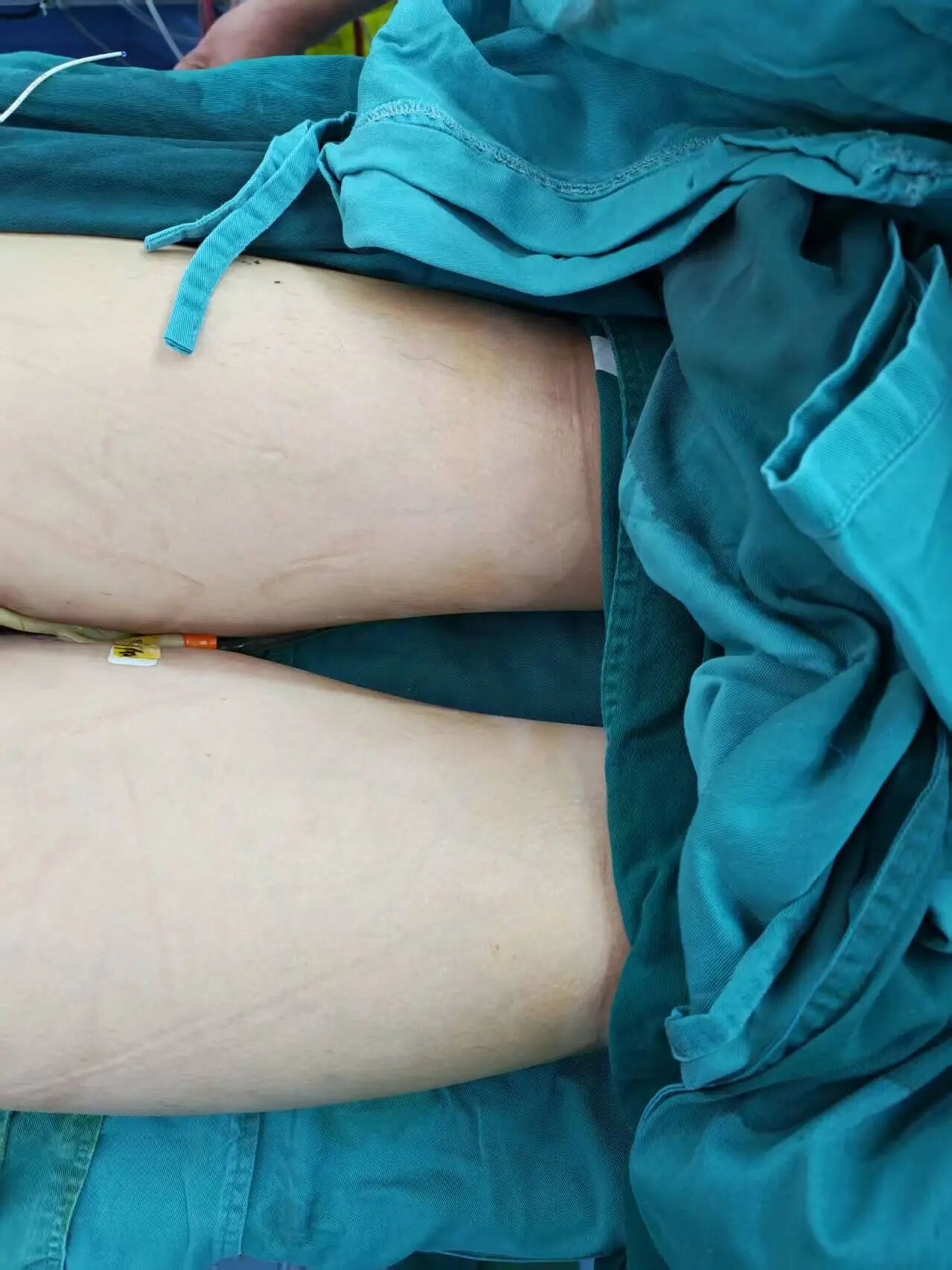 多学科无缝联动！南京江北医院心脏中心成功救治破裂休克 A 型主动脉夹层，破解「致命夹层」危机