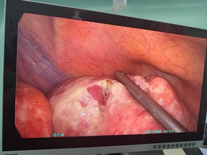 3 个「钥匙孔」完成肠切除，苏州明基胃肠外科精准微创技术