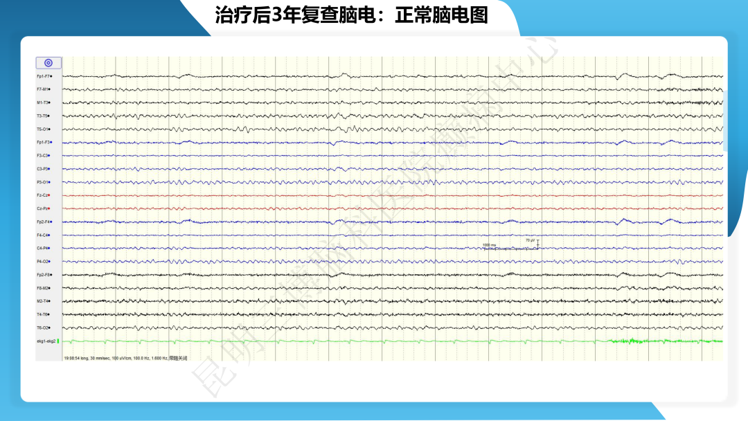 治疗抗 LGI1 抗体相关自身免疫性脑炎继发癫痫一例