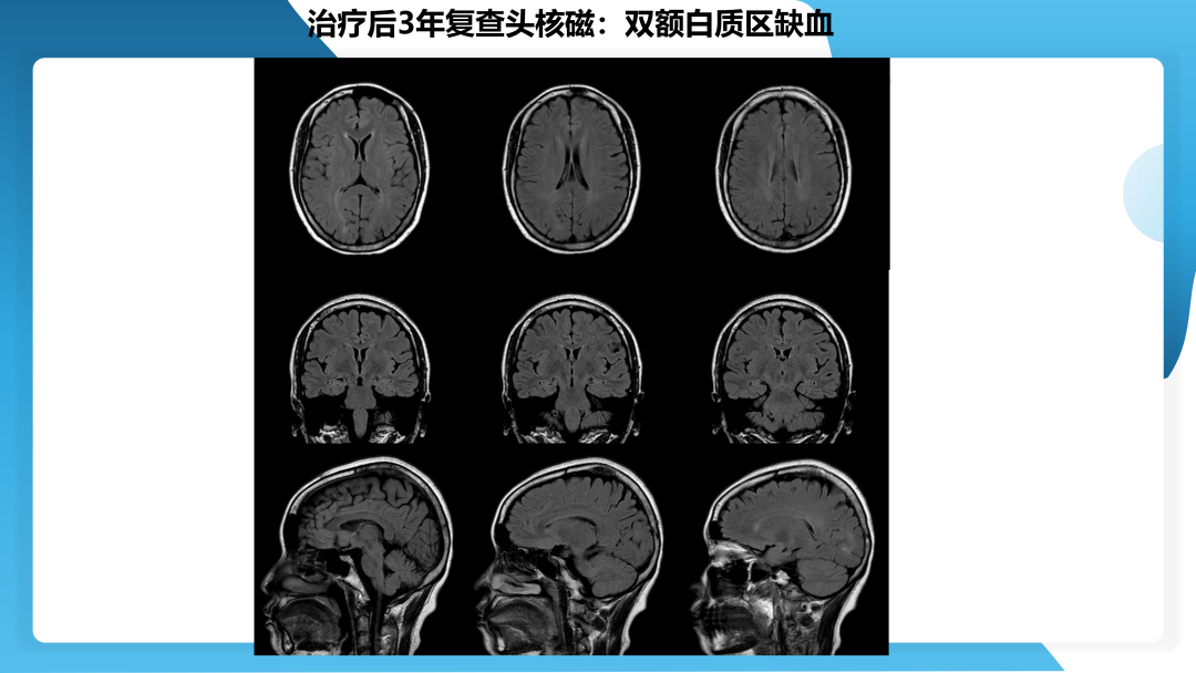 治疗抗 LGI1 抗体相关自身免疫性脑炎继发癫痫一例