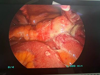 3 个「钥匙孔」完成肠切除，苏州明基胃肠外科精准微创技术